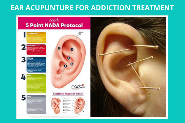 NADA Ear Treatments for Addiction